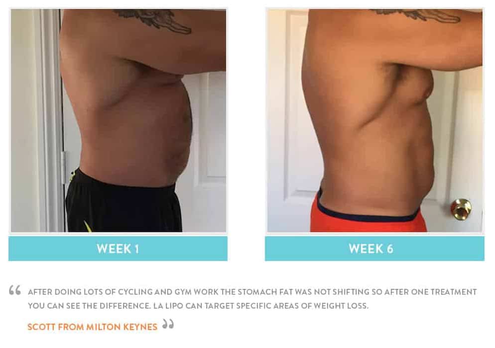 Before & After Stomach Fat Gateshead
