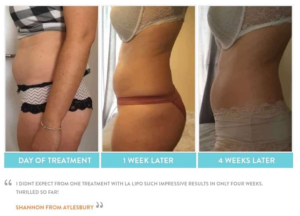 before, Cryolipolysis Gateshead