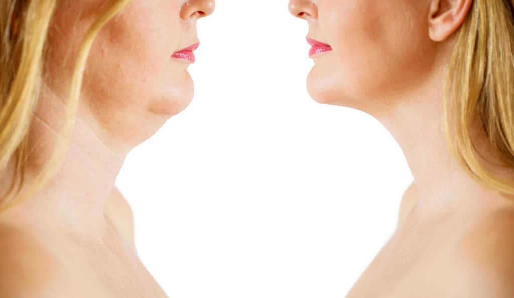 Double Chin treatment Gateshead before and after results