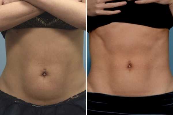 body sculpting FAQs Gateshead