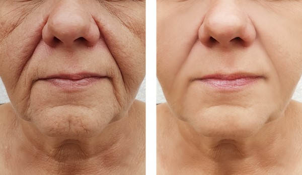 Learn more about Morpheus8 Treatment Gateshead today!
