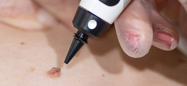 After Skin Tag Removal Gateshead