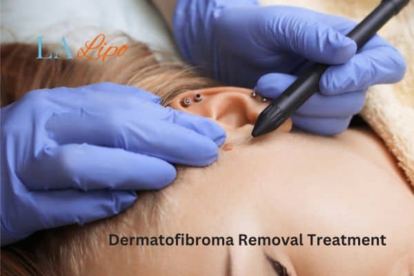Dermatofibroma Removal Treatment Gateshead