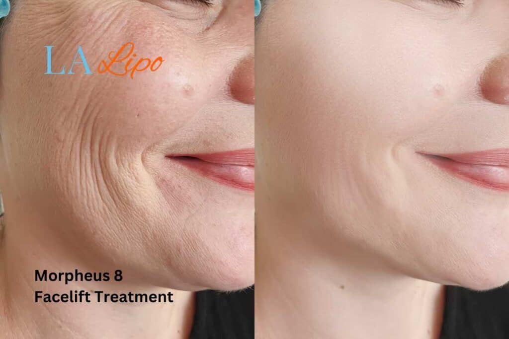 Morpheus8 Treatment Gateshead for flawless skin! Call us today!