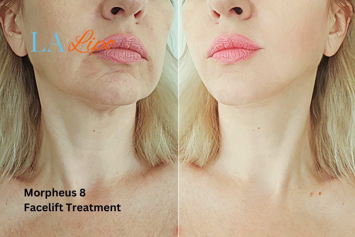 Turn back time with Morpheus8 Treatment Gateshead