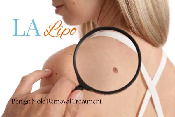 Why getting moles removed Gateshead can boost your confidence!