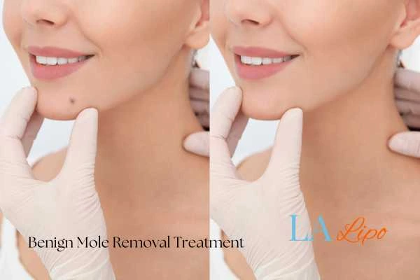 Woman's before and after results of being moles removal treatment Gateshead