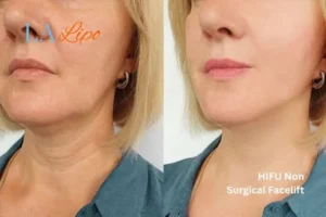 hi-fu for wrinkles Gateshead before and after results