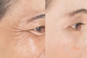 Before and after results of woman - HI-fu wrinkles reduction treatment Gateshead