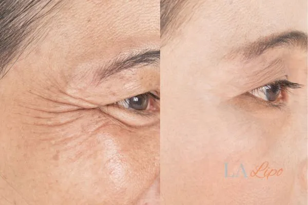 Before and after results of woman - HI-fu wrinkles reduction treatment Gateshead