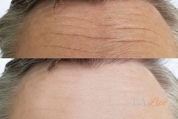 results of HIFU Gateshead on mans forehead to help reduce lines and wrinkles