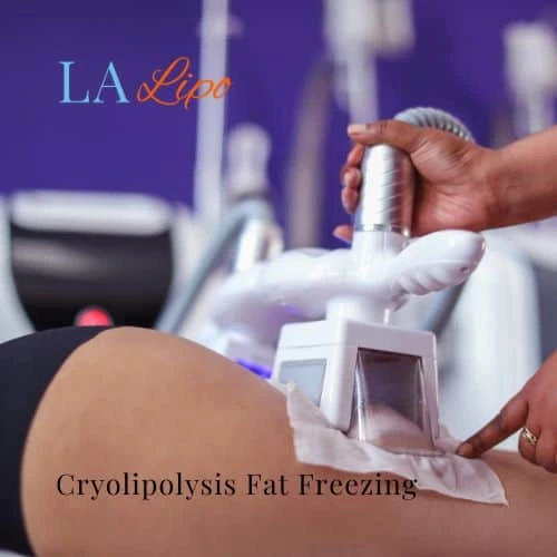 fat freezing - Cryolipolysis Gateshead