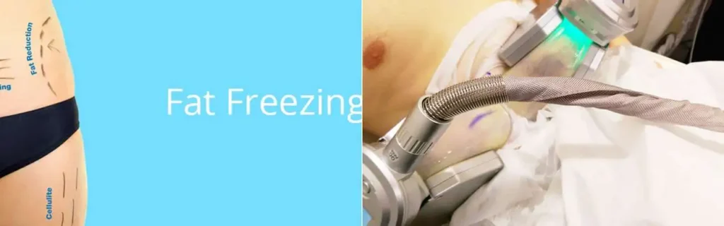 Fat freezing Gateshead on multiple areas of the body