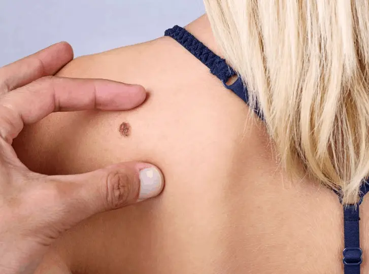woman having mole removal Gateshead consultation before treatment.