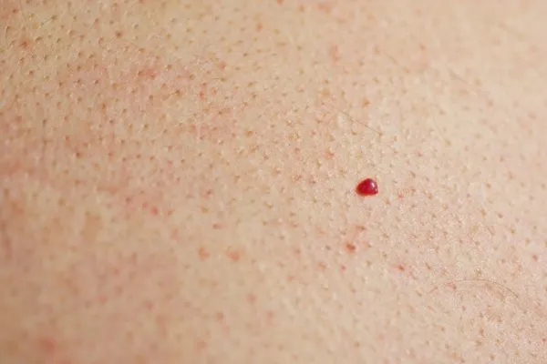 close up of a cherry angioma Gateshead