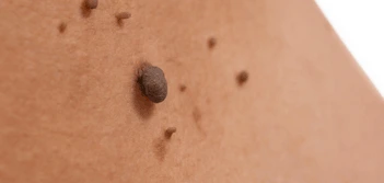 image of a skin tag Gateshead