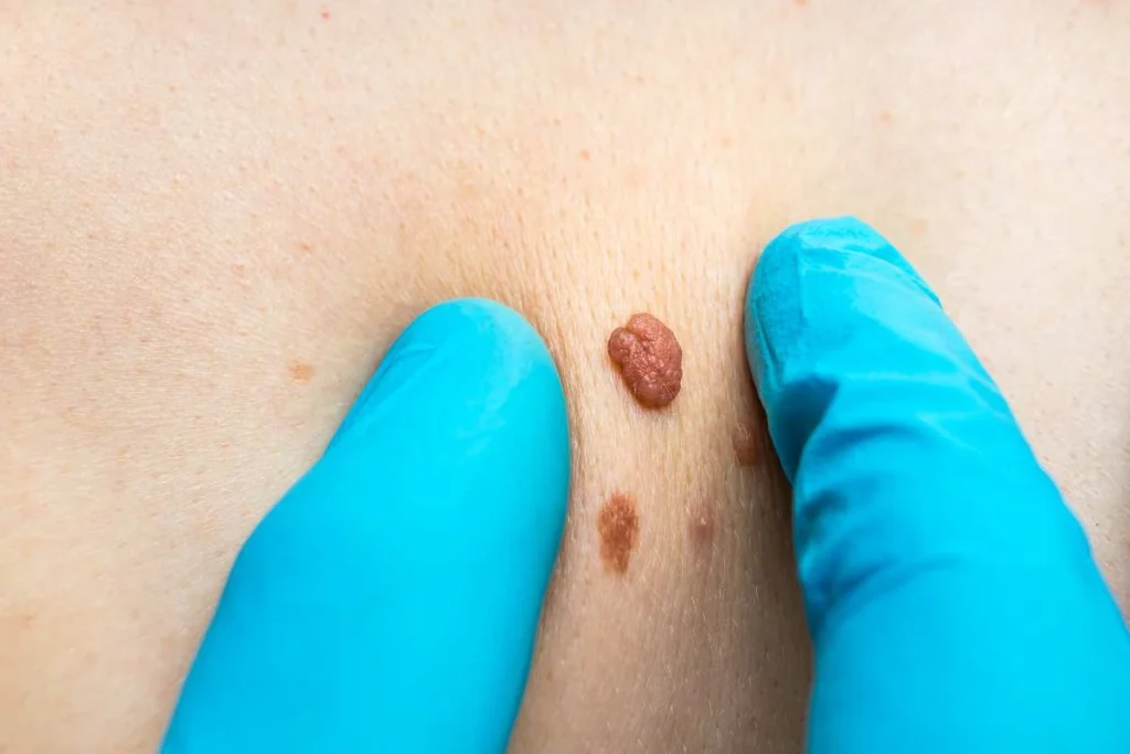 Consultant examining a skin tag Gateshead