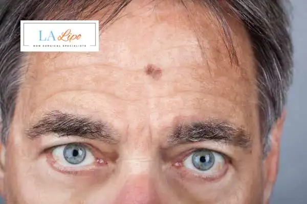 Solar Lentigo Removal Gateshead image of man with mark on his forehead