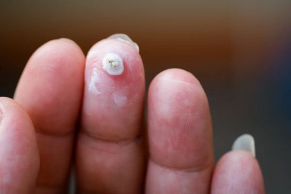 wart on person finger - cryotherapy to treat from LA LIPO Gateshead
