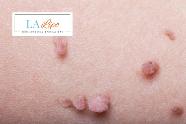 Does cryopen skin tag removal Gateshead hurt? Find out now call our team today!