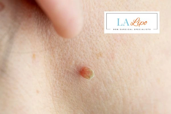 Book skin tag removal Gateshead today speak to our team now!
