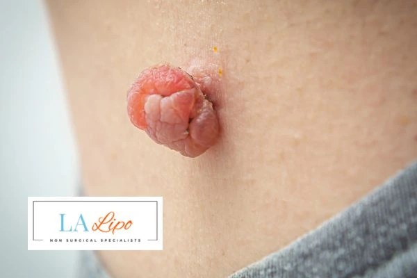 Interested in skin tag removal Gateshead? Concerned about the pain? Find out more today!