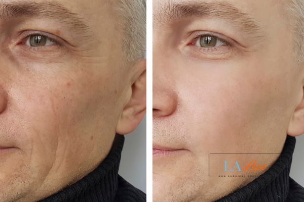 See the amazing results of Morpheus8 Treatment Gateshead!