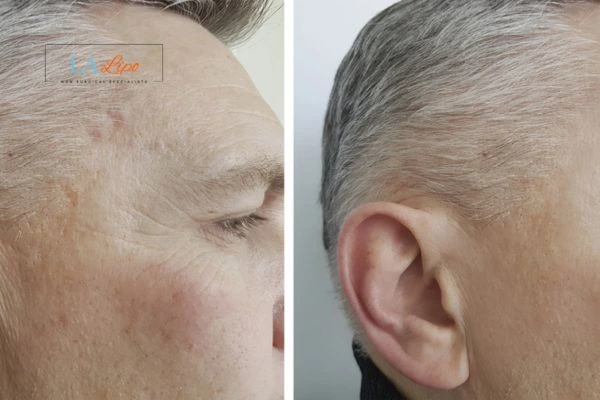 Mens Before & After Morpheus 8 Results Gateshead