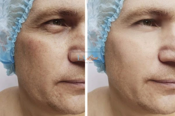 Before and after Morpheus 8 Results Gateshead