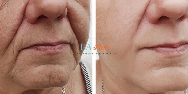 Older lady deeper wrinkle reduction - LA LIPO Morpheus 8 Results Gateshead