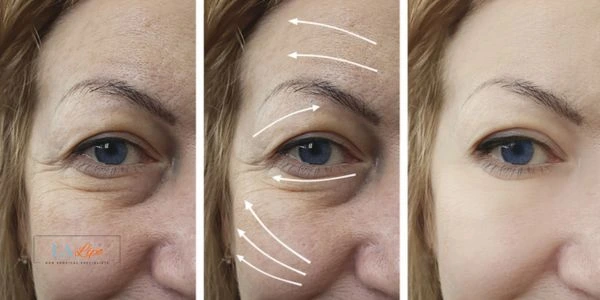Amazing eye lift Morpheus 8 results Gateshead