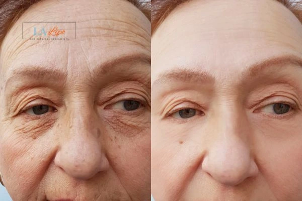 The powerful benefits of Morpheus8 Treatment Gateshead - Call Our team today!