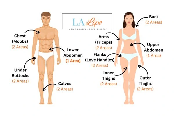 LA LIPO Cryolipolysis Areas Gateshead