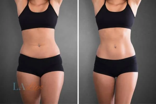 before and after results of non-surgical treatment to help a woman's body image and mental health Gateshead
