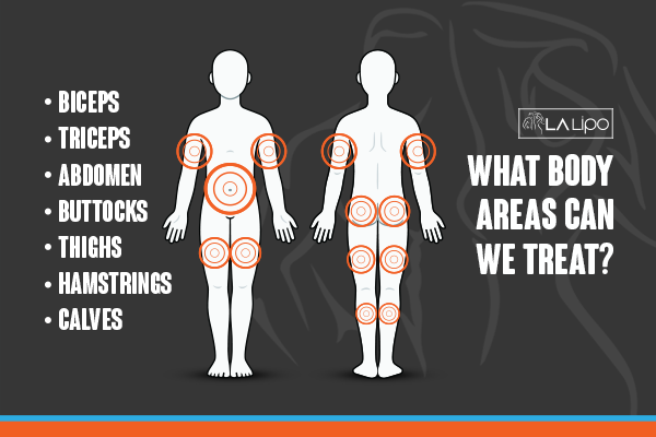 Diagram to show areas you can have LA-EMS Body Sculpting Treatment Gateshead
