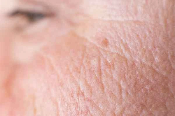 close up picture of a woman's face showing an age spot Gateshead