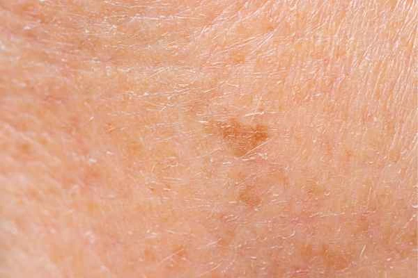 close up picture of age spots Gateshead
