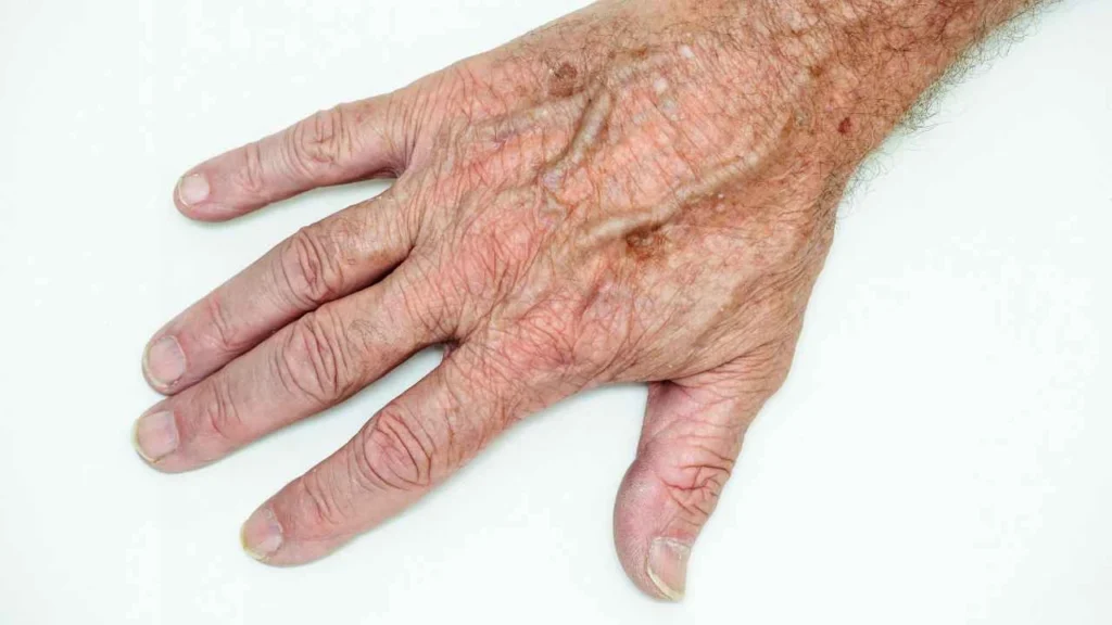 Male hand showing age spot Gateshead