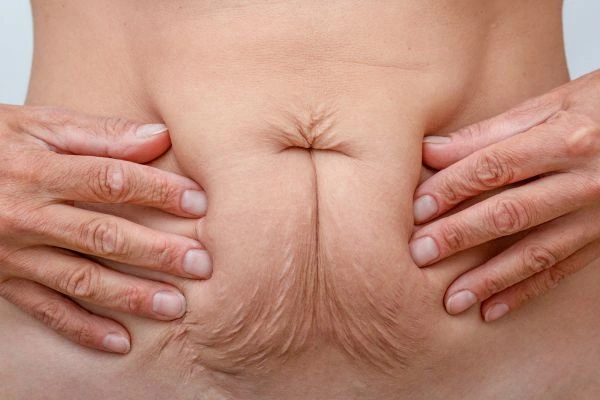 Image of a woman's stomach with loose skin - example of skin tightening Gateshead options