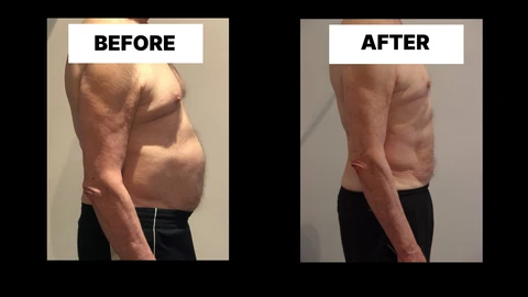What Symptoms Can Diastasis Recti Cause in Men? Weak Core, Back Pain and Poor Posture Gateshead